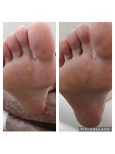 遊歩堂/ヒールダコに魚の目