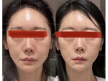 プリマヴェーラ/二重顎にエラ張りお任せください