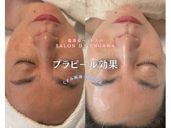 サロンドエンガワ(Salon de ENGAWA)/プラピールの効果