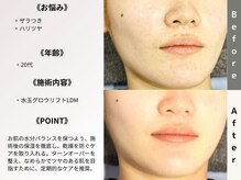 ルディラ 恵比寿店/水玉グロウリフト(韓国式LDM)