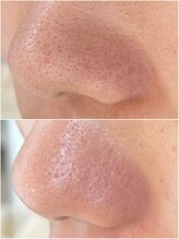 ニュートラル(neutral)/毛穴エクストラクションプロ大分