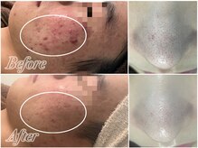 アンドナイン エス店(ANDNINE.)/毛穴洗浄、ハーブピーリング