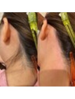 サロン クベル(Salon Kvell)/うなじWax＋光脱毛