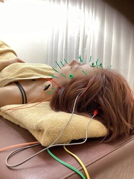 Noa接骨院 はりきゅう院の写真/《効果重視の方必見☆》お顔の悩みは【美容鍼】で解決！肌質改善/リフトアップ/むくみ解消/クマ・シミ改善