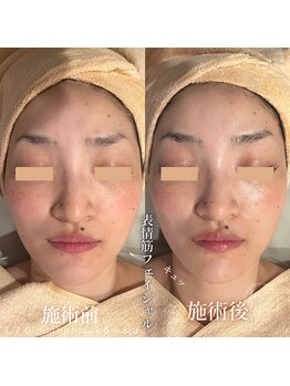 マノマノ エミュー(manomano emu)/【小顔】ビフォー&アフター