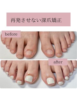 ティアラネイル(tiaranail)/再発させない深爪矯正