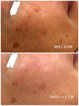 ディス イズ ミー エステティック(This is Me Aesthetic)/シミケアモニタープラン