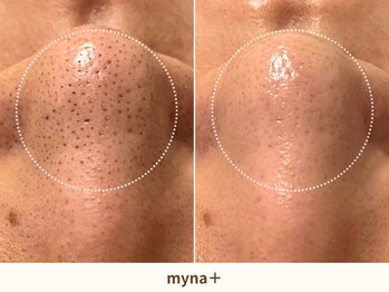 マイナプラ 表参道(myna+)/ハイドラ毛穴洗浄/肌質別マスク