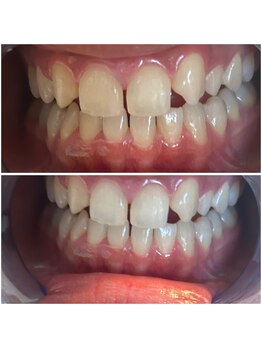 エクシアホワイトニング 代々木店/ホワイトニングビフォーアフター