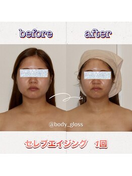 ボディグロス 梅田店(BODY GLOSS)/セレブエイジング1回【小顔】