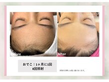 サロン ド メタセコイア(salon de Metasequoia)/【ジュニア脱毛】before／after