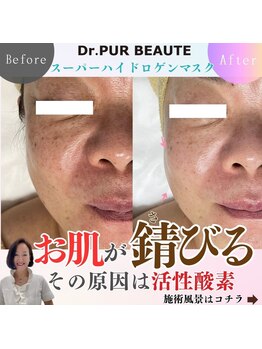 エステティックサロン ラ アクア(ra aqua)/お肌が錆びる?!活性酸素除去