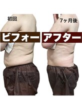 SDルーム/ラジオ波・キャビテーション