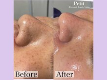 プティ 六本木店(Petit)/ハイドラフェイシャル