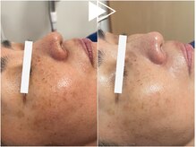 リシェス(Richesse)/シミ改善ハーブ★初回¥9990