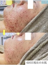 クレヴィー(Creviy)/陶肌トリートメント6回の変化