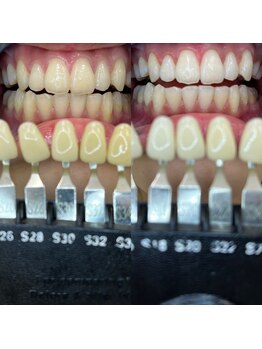 トウキョースワーズ 渋谷店(TOKYO SWRS)/#ホワイトニング #渋谷 #池袋