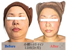 マリス(MARISS)/小顔たるみケア【小顔/毛穴】