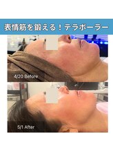 癒える(ielu)/小顔テラボーラー 1ヶ月のBA