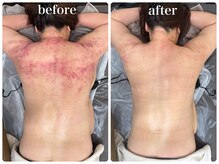 ブランシュムーニー(BRANCHE MOONY)/クラッシュ＆脂肪冷却の併用♪