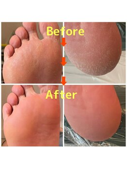 SDルーム/角質ケア　ビフォーアフター