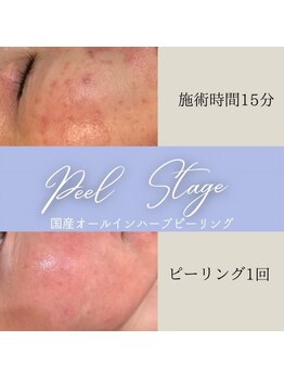 ナチュライズ(NatuRise)/ニキビお悩みの方へ
