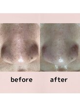 メイト(mate)/毛穴エクストラクションtete式