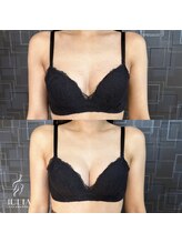 ジュリア(JULIA)/【バストアップ/育乳　症例】