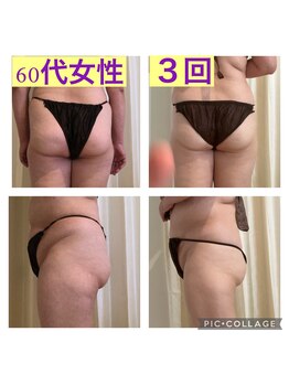 美活くらぶ/痩身 ビフォーアフター