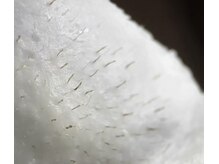 雅菜(miyabina)/WAX脱毛！産毛に絡みついた皮脂