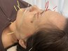 大人気【皮膚のお悩み解消&疲労回復】お試し水素美容鍼（全身鍼灸込み）