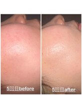 ミニョン(mignon)/肌質改善中！