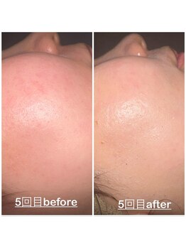 ミニョン(mignon)/肌質改善中！