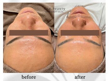 アン ビューティー(ann beauty)/【症例写真】30代男性