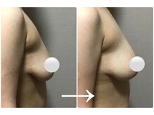 バストアップの施術の様子/1回で違いを感じる方多数