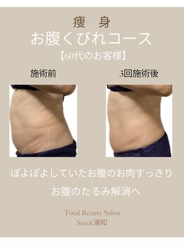 ストック 浦和(Stock)/【痩身】浮き輪肉もすっきり