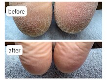 カシェット(Cachette)/30代女性◎足裏角質ケア90分