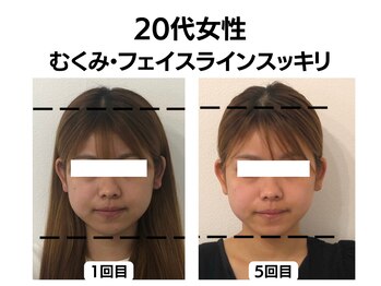 シン(SHINE)/美容鍼灸