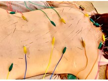 リボディエステアンド整体(Rebody)/はり