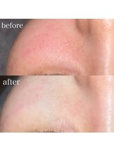 薫風/フェイシャルワックス／20代