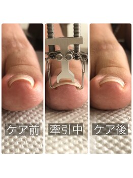 巻き爪ケア