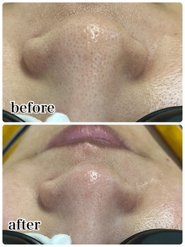 ケースタイル(k.style)/小鼻の黒ずみbefore after