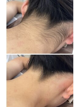 ルプリュシュ ルフレ(Le plus reflet)/脱毛