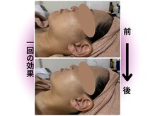 カリアンヌ/小顔・リフトアップ・毛穴改善