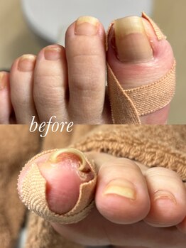 リゼラアンドコー 柏原店/痛くて歩くのがつらい…