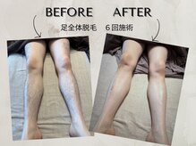 ワンアップ(One-up)/足全体脱毛 ６回　before  after