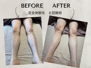 ワンアップ(One-up)/足全体脱毛 ６回　before  after