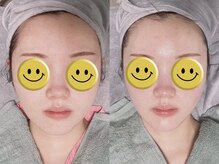 ホワイティアビシェル 浦和(Whitia Vishell)/【フェイシャル】小顔リフト