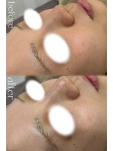 サロンドチュラ(salon de chula)/プラズマ/毛穴ケア/美白ケア