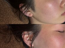 ゴールデンエイジ 吉祥寺(GOLDEN AGE)/ワックス脱毛：施術